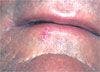 Actinic Cheilitis in a 53-Year-Old Man