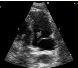 Benign Papillary Fibroelastoma: A Not-So-Rare Primary Cardiac Tumor?