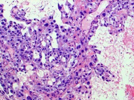 Yolk Sac Tumor in the Anterior Mediastinum: A Rare Case