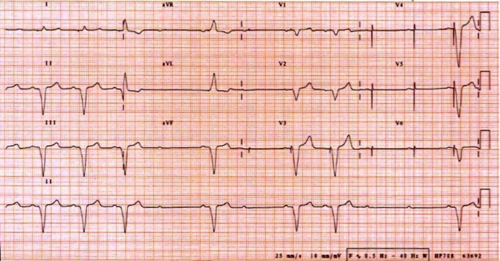 Pacemakers and AICDs: The ABCs