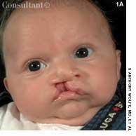 Cleft Lip and Palate