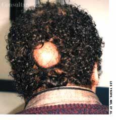 Sebaceous Cyst