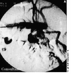 Renal Artery Stenosis