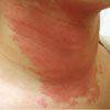 Allergic Contact Dermatitis From Tea Tree Oil