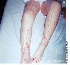 Leukocytoclastic Vasculitis