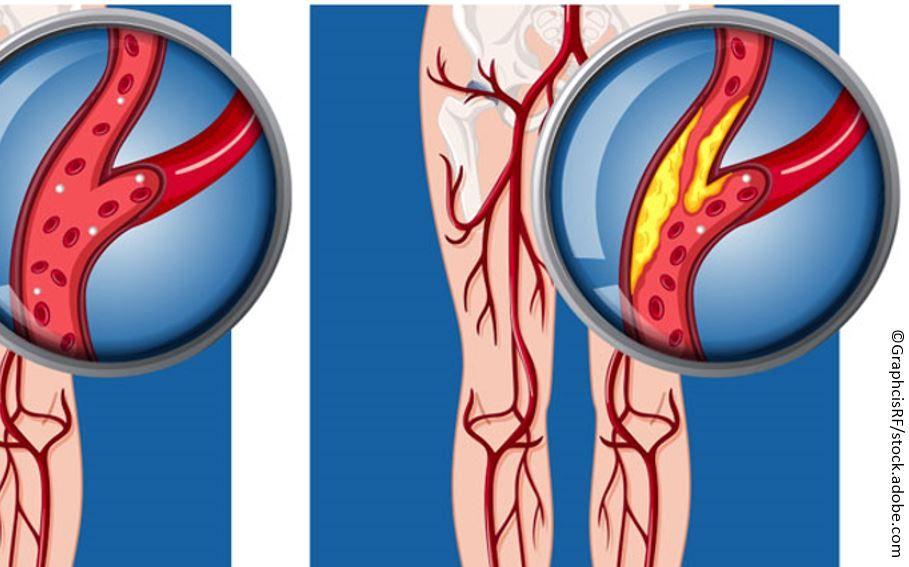 Peripheral arterial disease, claudication, hypertension