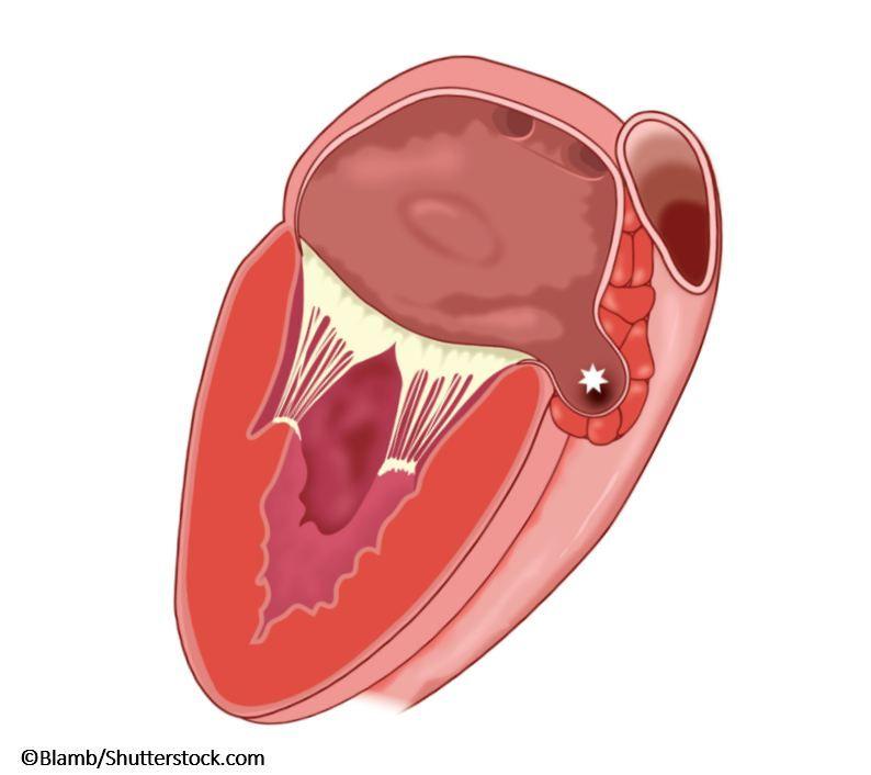 Prophylactic LAA Closure for Stroke Prevention in AF: Is it Really As Good An Idea As We Thought?