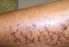 Erythema ab Igne in a 66-Year-Old Black Woman