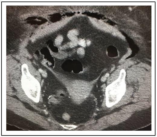 Fournier's gangrene, necrotizing soft tissue infection 