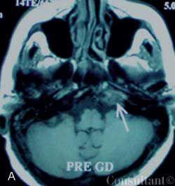 Facial Paralysis