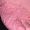 Long-standing Tinea Pedis