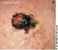 Superficial Spreading Melanoma