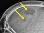 An Elderly Woman With IgA Lambda Multiple Myeloma and Kidney Disease