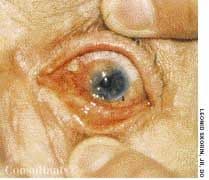 Squamous Cell Carcinoma in the Eye