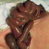 Gastroschisis