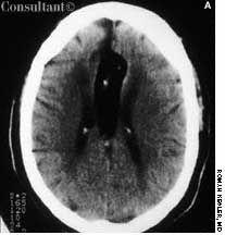 CNS Lipoma