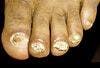 Reactive Arthritis (Reiter Syndrome) Mimicking Onychomycosis