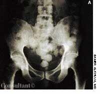 Tuberculous Osteomyelitis