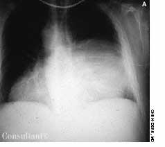 Posterior Mediastinal Thymoma