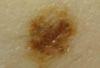 Dysplastic Nevus