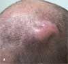 Perifolliculitis Abscedens Et Suffodiens