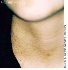 Zosteriform Lentiginous Nevus