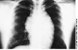 T-Cell Acute Lymphoblastic Leukemia and Mediastinal Mass