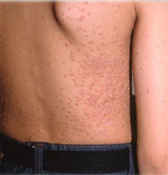 Crash Rash Quiz: 8 Psoriasis Questions