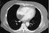 Mediastinal Lipomatosis