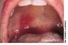 Aphthous Stomatitis: Three Types