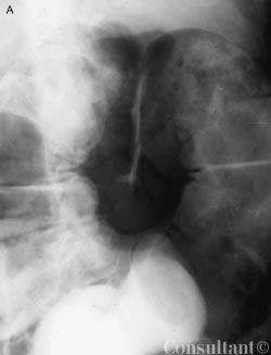 Acute Colonic Pseudo-obstruction