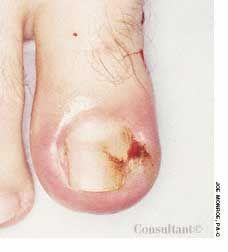 Ingrown Toenail