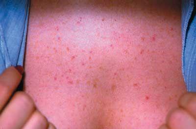 Folliculitis: Part I