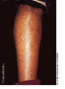 Idiopathic Guttate Hypomelanosis