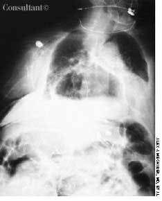 Paraesophageal Hiatal Hernia