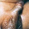 Pearly Penile Papule