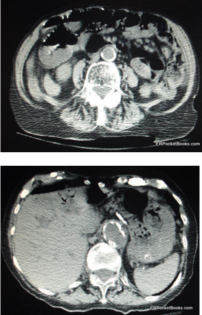 Ischemic colitis with perforation 