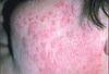 Why has a topical corticosteroid failed to clear this rash?