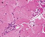 Acute Rhabdomyolysis From Dermatomyositis