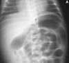 Small Left Colon Syndrome