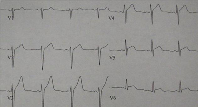 Myocarditis presenting with symptoms of URI 