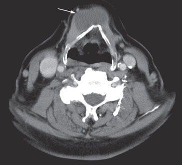 Firm, Nontender Mass on the Neck: Your Dx?