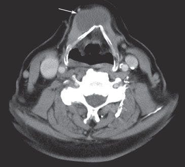 Asymptomatic Neck Mass