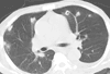 Fever, Dyspnea, and Pleuritic Chest Pain in a Man Started on Hemodyalisis