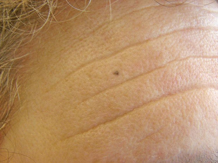 Small Dark Spot on Forehead