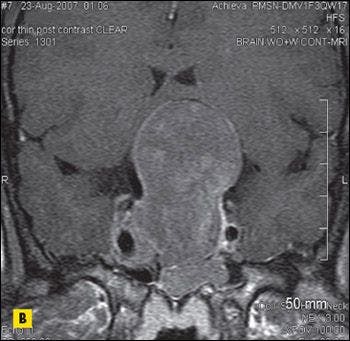 Acromegaly: A Pop Quiz