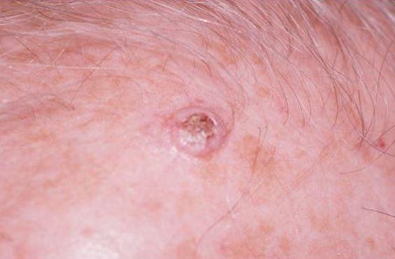 Squamous Cell Carcinoma of the Scalp