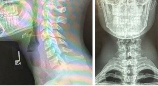 Neck X-ray, 2 views