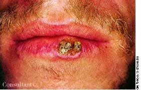 Squamous Cell Carcinoma of the Lip