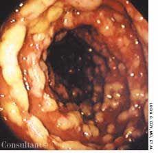 Pseudomembranous Enterocolitis in a Woman With Hypertension, Diabetes Mellitus, and Congestive Heart Failure